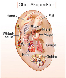 Ohrakupunktur